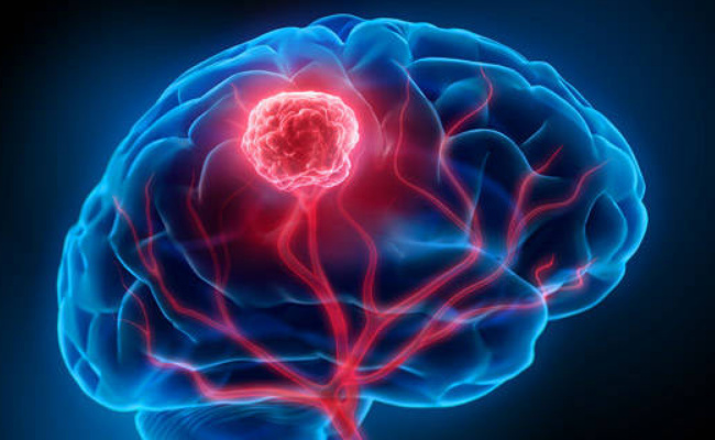 ​抗脑癌的首个“量子疗法”找到 有哪些意义