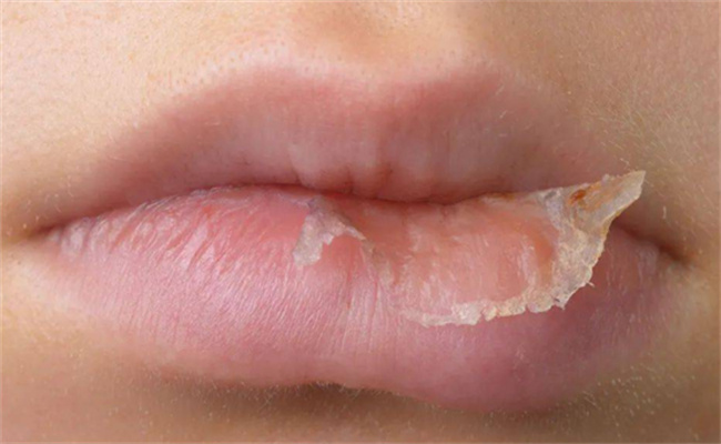 反复口腔溃疡嘴唇起皮是什么原因   嘴唇起皮是什么原因
