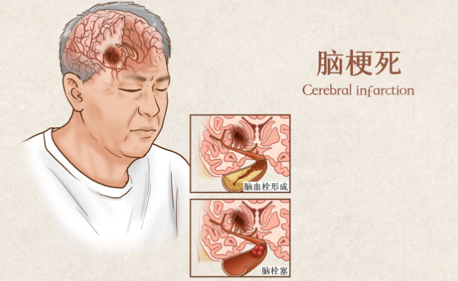 脑供血不足不宜吃什么食物  脑供血不足有什么症状