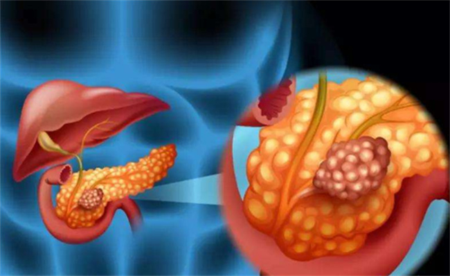 查出胰腺癌能活过5年的人不足10%吗